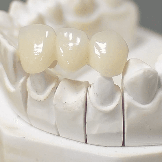 Dental crowns and bridges treatment at Canopy Dentistry