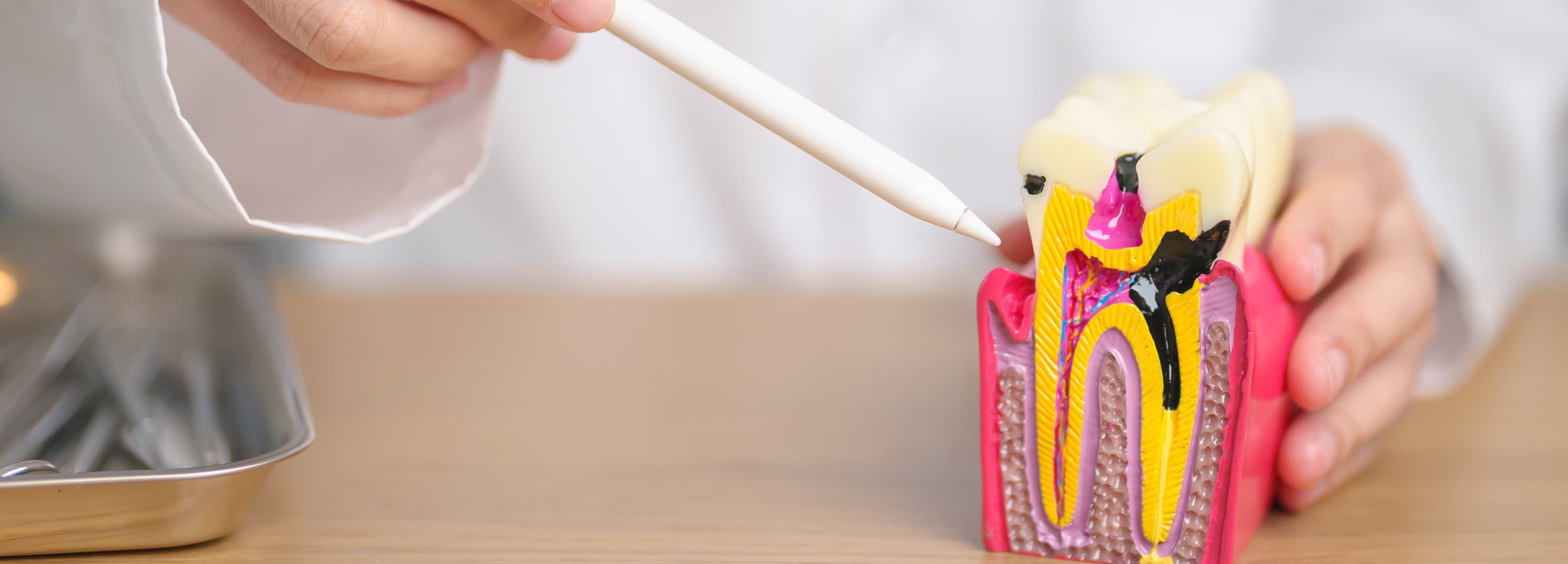 Tooth model showing decay reaching the root canal
