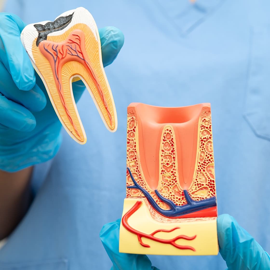 Tooth models showing decay and the root canal