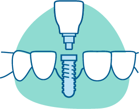 dental implant icon